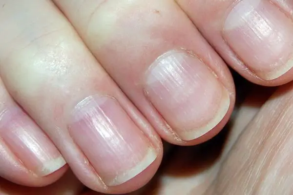 fibromyalgia and Brittle Nails